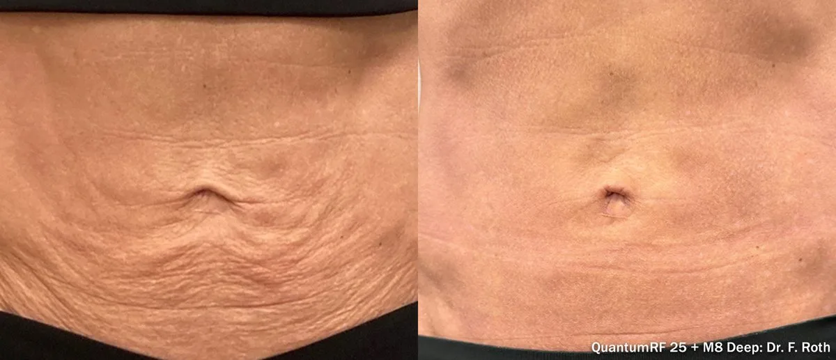 Antes y después de Morpheus8 Burst Deep en abdomen