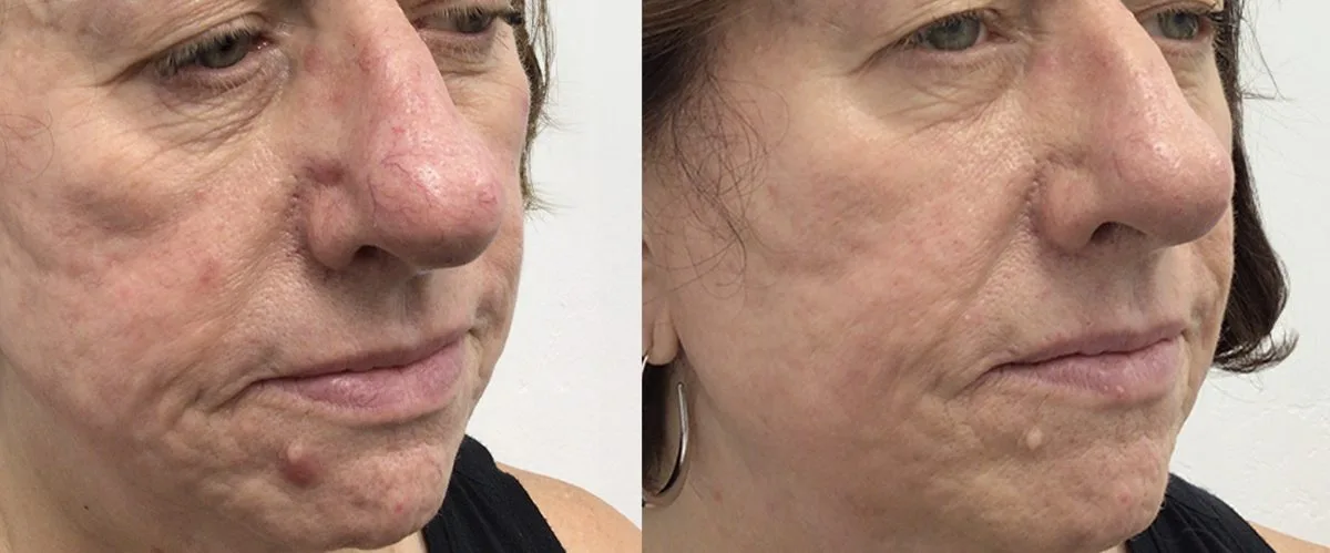 Antes y después de Morpheus8 en rostro — calidad de piel