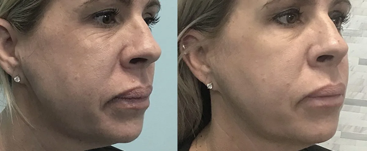 Antes y después de Morpheus8 en rostro — firmeza