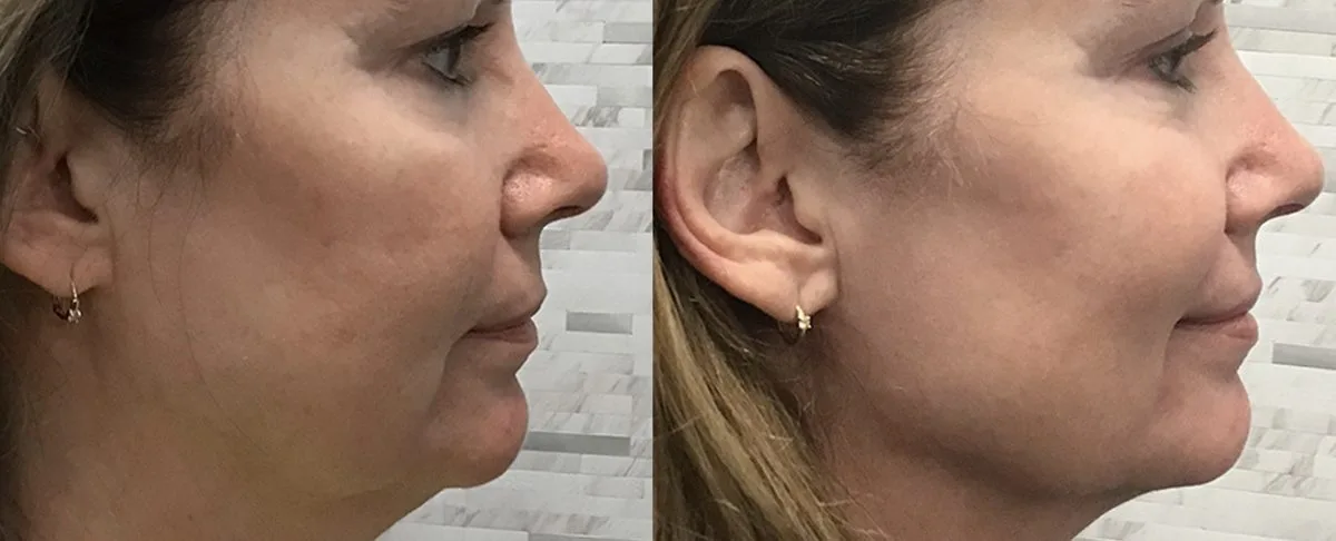 Antes y después de Morpheus8 en papada y cuello