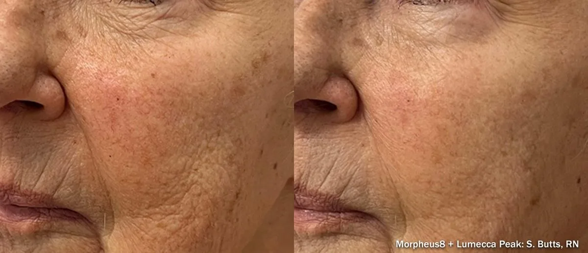 Antes y después de Morpheus8 en rostro — piel