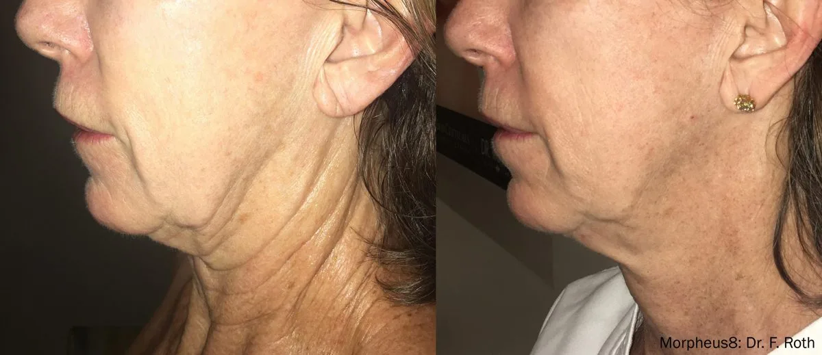 Antes y después de Morpheus8 facial