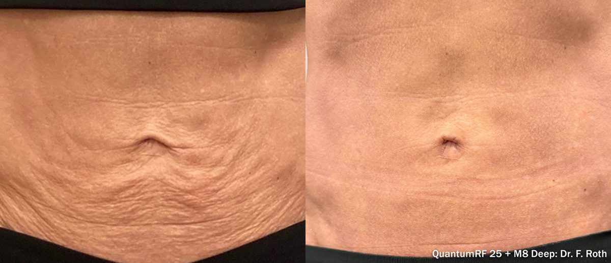 Antes y después de Morpheus8 Burst Deep en abdomen